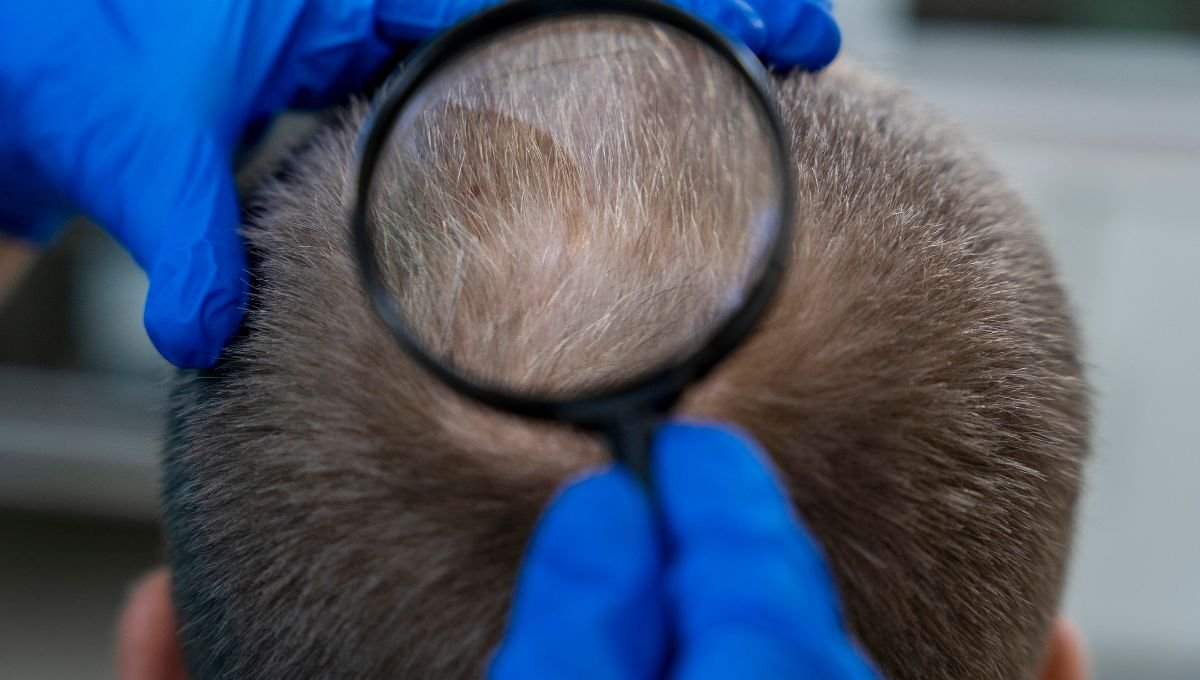 The Science Behind Hair Loss and How Transplants Can Help